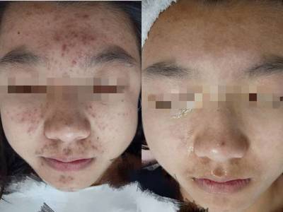 你有你的美图秀秀 我有我的水杨酸